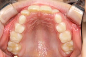 歯列全体が小さく前歯が並ぶスペースが不足していました
